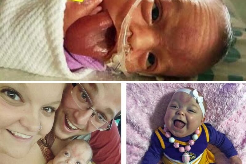 Baby Born with a Giant Tongue—Her Transformation Today Will Leave You Speechless!
